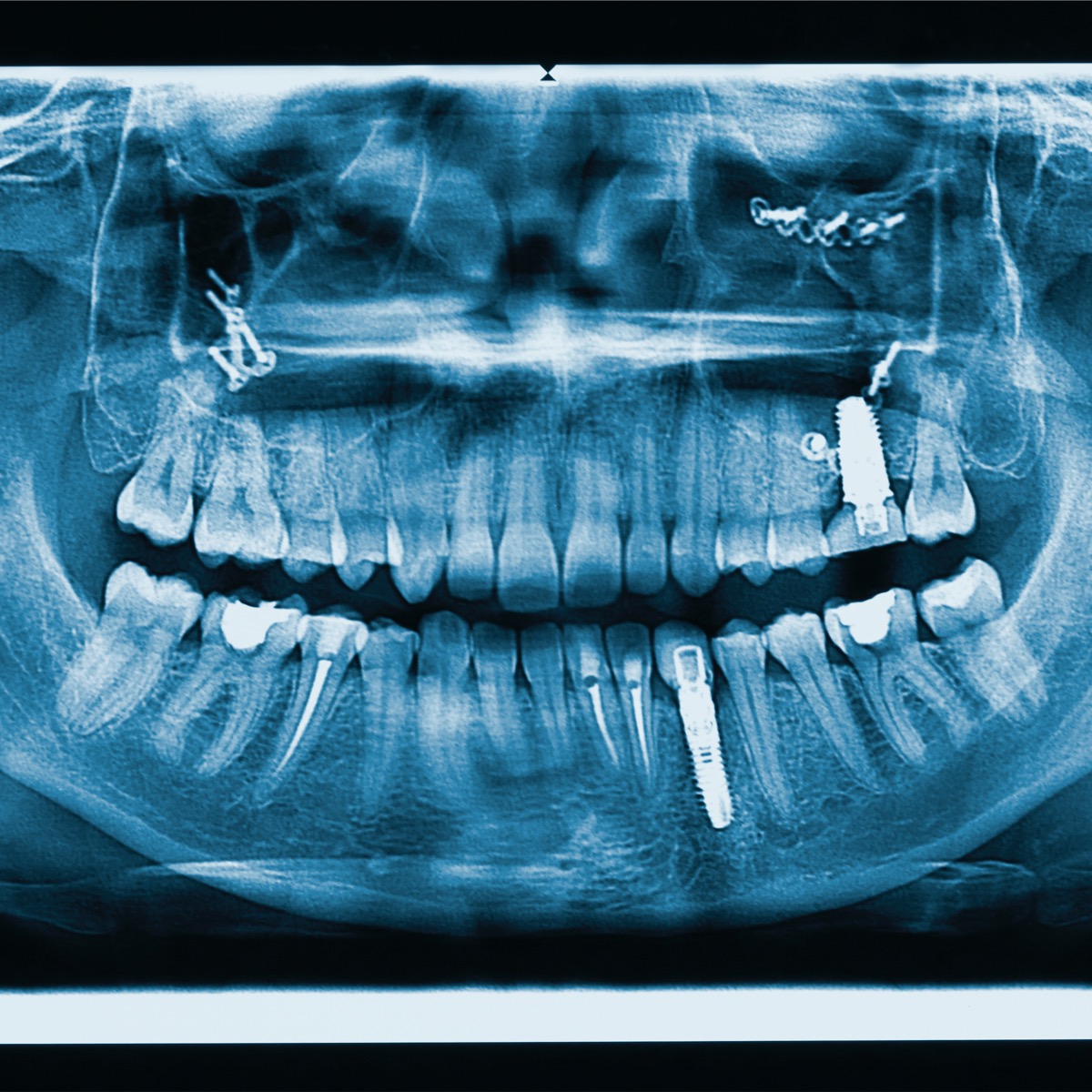 Implantat X-ray